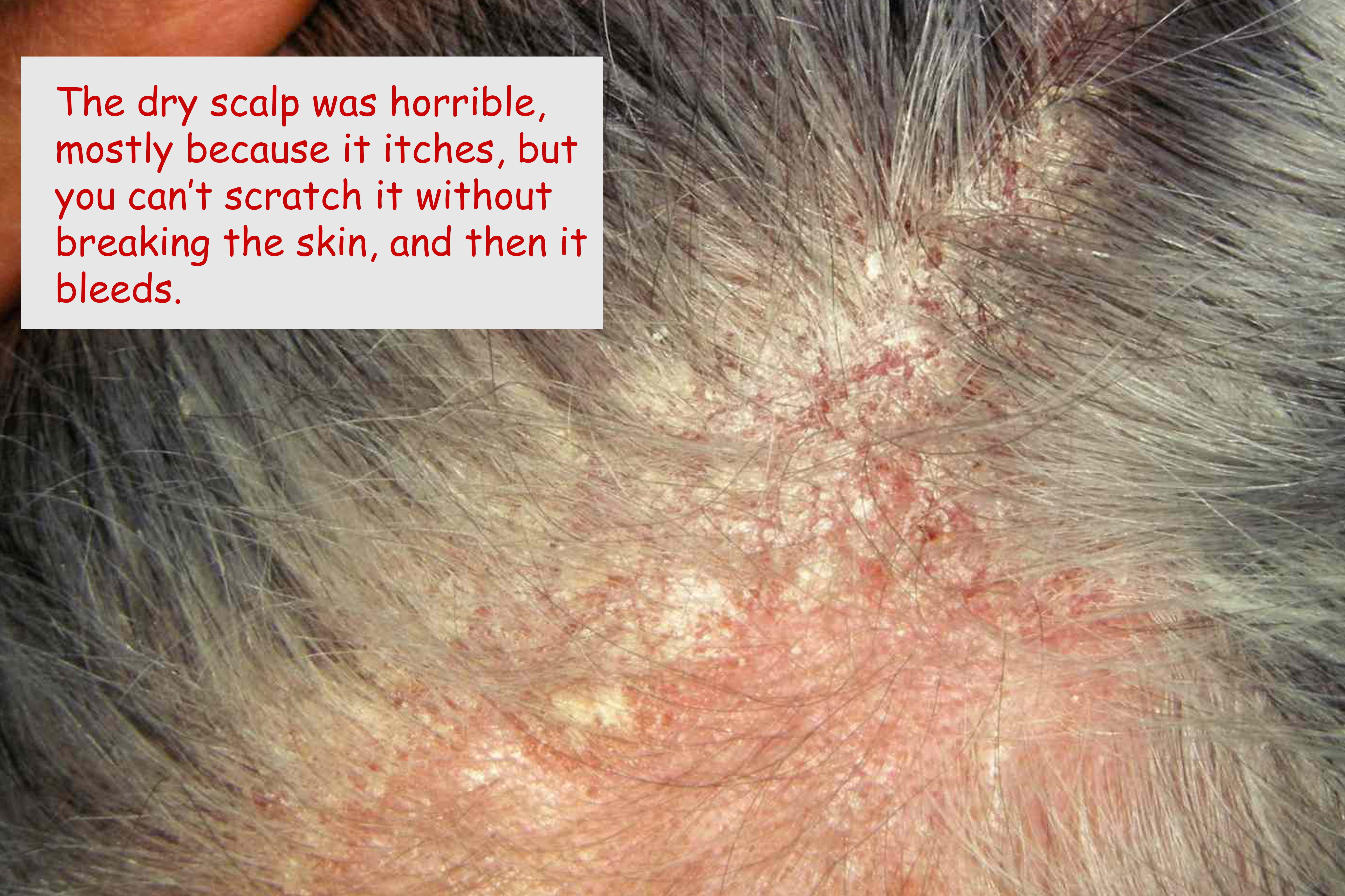 Inflamed vs. healthy scalp illustration