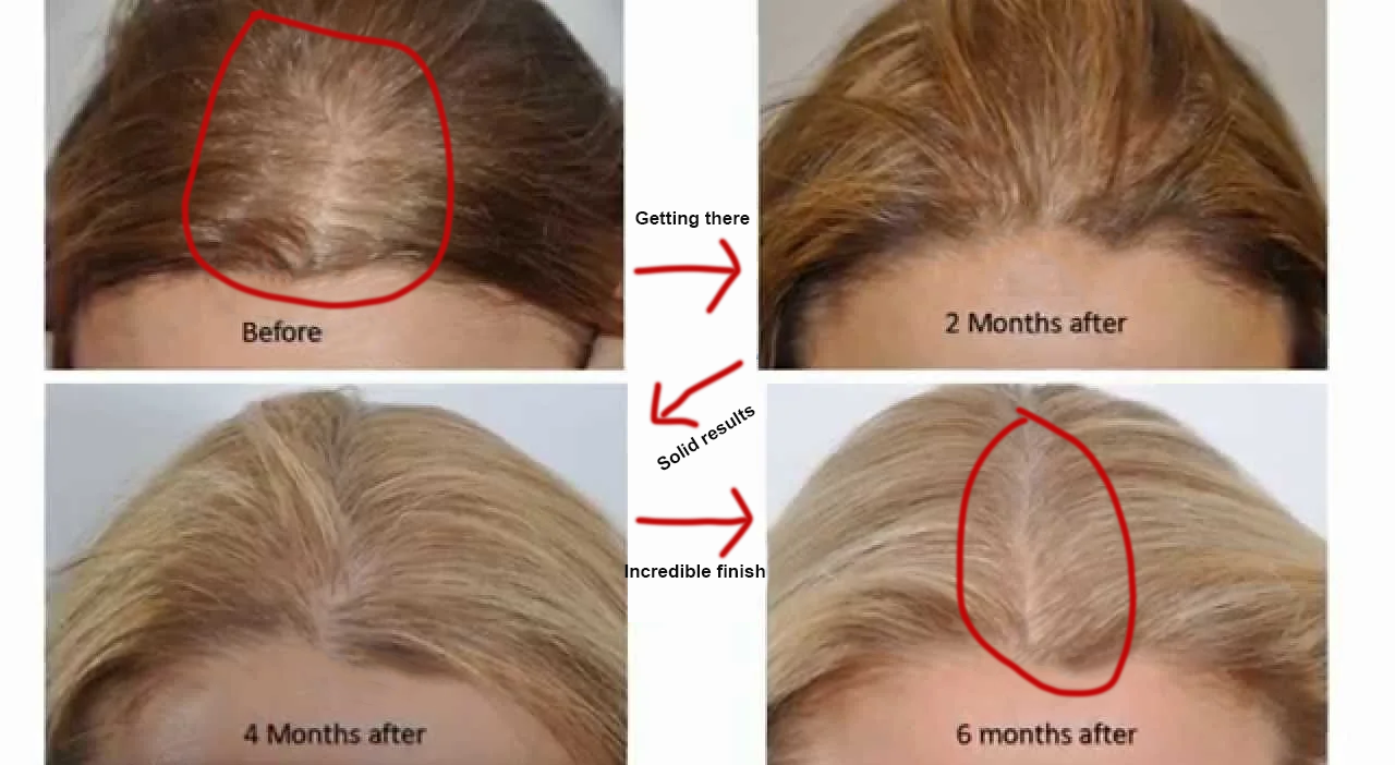 Before and after photo series, Month 1 to 6